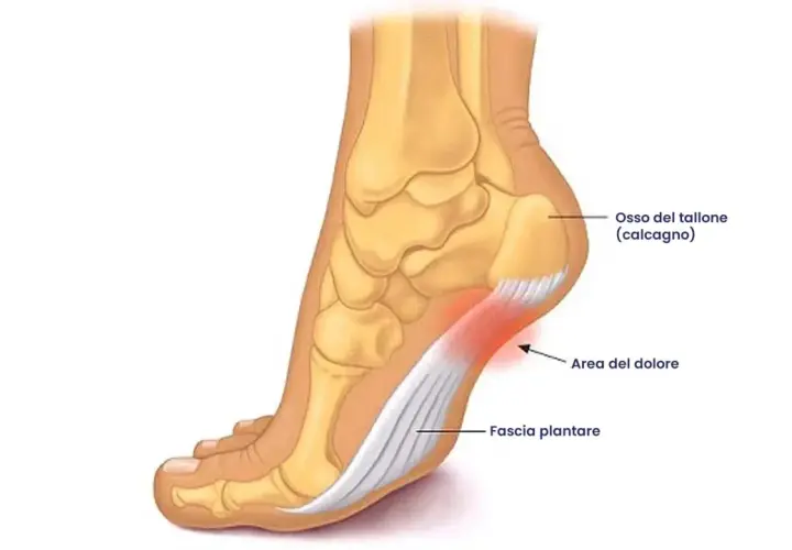 Illustrazione anatomica del piede che mostra l'osso del tallone e la fascia plantare. L'area rossa indica il dolore, spiegando perché viene la tallonite.