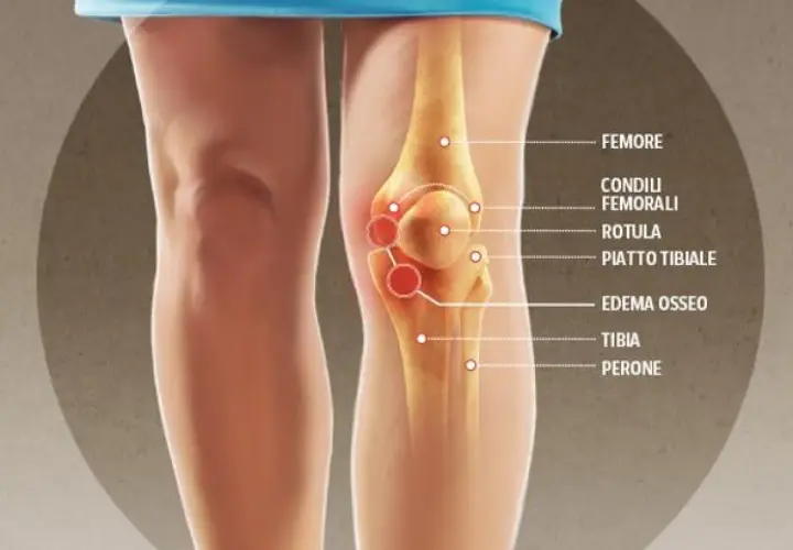 Illustrazione anatomica del ginocchio con evidenziato l'edema osseo.