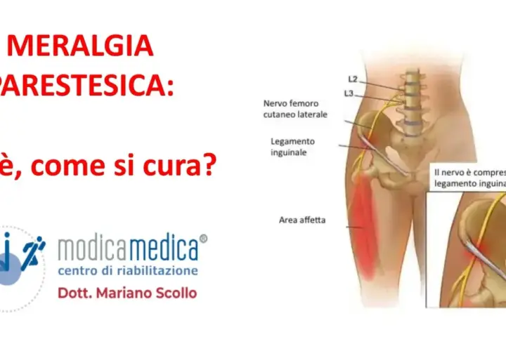 Meralgia parestesica: illustrazione del nervo femorale compresso, con sintomi e area affetta.