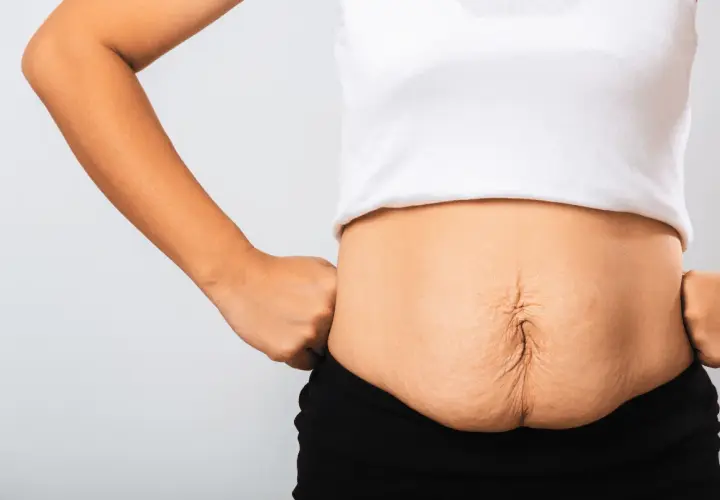 Addome con smagliature e diastasi addominale: cosa fare per recuperare tonicità e benessere.