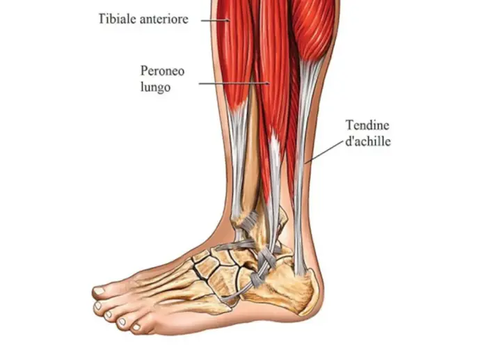 Dettaglio anatomico della gamba e del piede, con evidenziato l'ispessimento del tendine d'Achille.