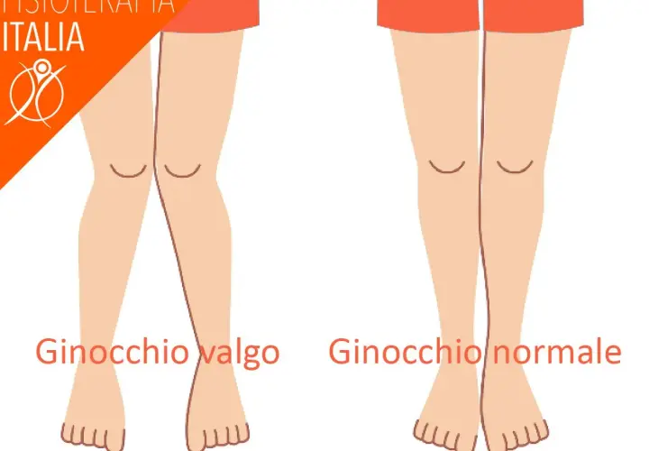 Confronto ginocchio valgo e ginocchio normale, utile per il valgus stress test.
