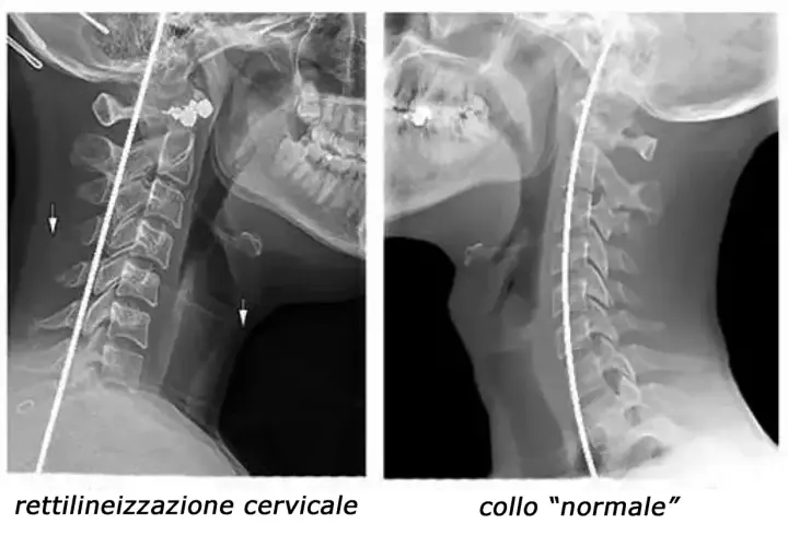 Radiografie del collo: a sinistra, rettilineizzazione cervicale con riduzione della lordosi; a destra, collo "normale".