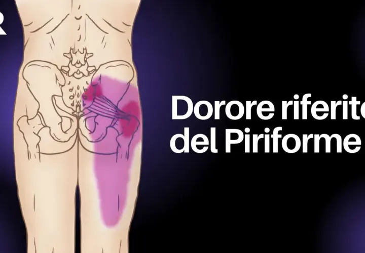 Dolore riferito del piriforme: un'illustrazione anatomica mostra l'area del gluteo e della gamba interessata da infiammazione.