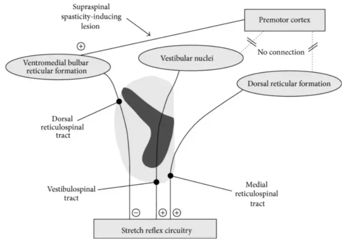 Schema che illustra la spasticità indotta da lesioni sovraspinali, con percorsi che influenzano il circuito del riflesso da stiramento, rilevante per la scala Ashworth.