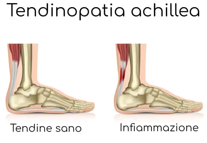 Confronto anatomico: tendine d'Achille sano e infiammato, causa di bruciore ai talloni a riposo.