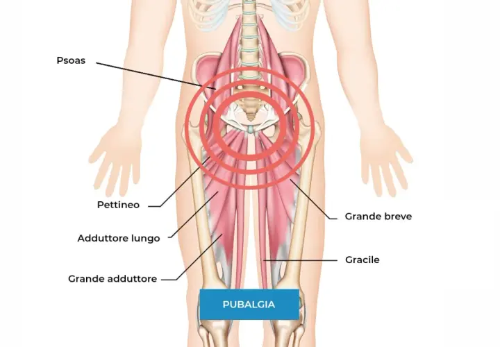 Illustrazione anatomica che mostra i muscoli adduttori e il psoas, aree spesso coinvolte nella pubalgia. Scopri i rimedi.