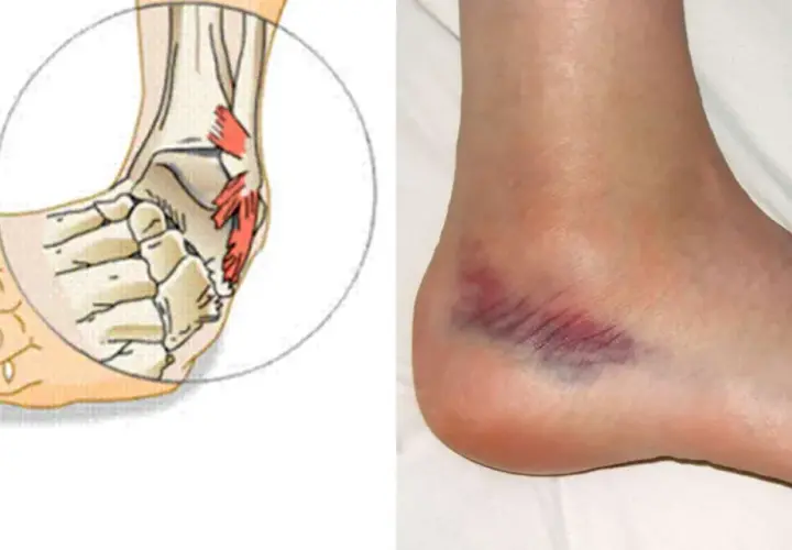 Illustrazione anatomica di una caviglia con evidenziata una lesione osteocondrale, accanto a una caviglia reale con ematoma.
