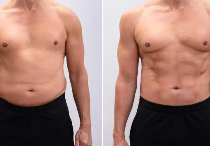 Uomo prima e dopo il trattamento per la diastasi addominale. La pinna addominale è visibilmente ridotta.