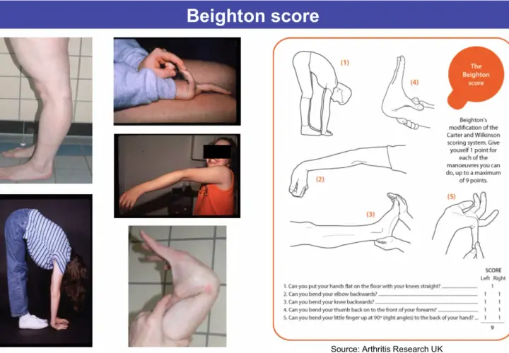 Valutazione dell'iperlassità articolare con il Beighton score. Immagini mostrano flessibilità di gambe, dita e schiena.