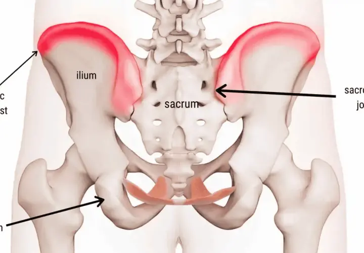 Anatomia del bacino con evidenziata la cresta iliaca. Il dolore alla cresta iliaca può avere vari sintomi.