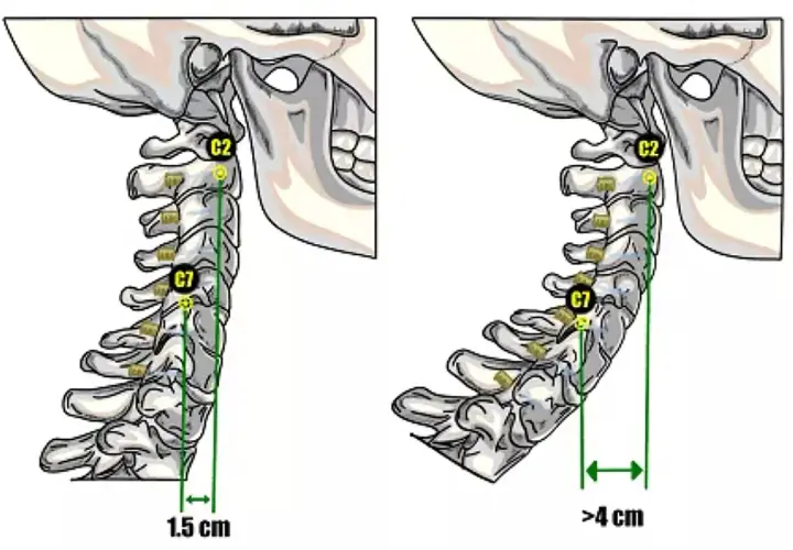 Confronto tra colonna cervicale normale (1.5 cm) e iperlordosi cervicale (>4 cm).
