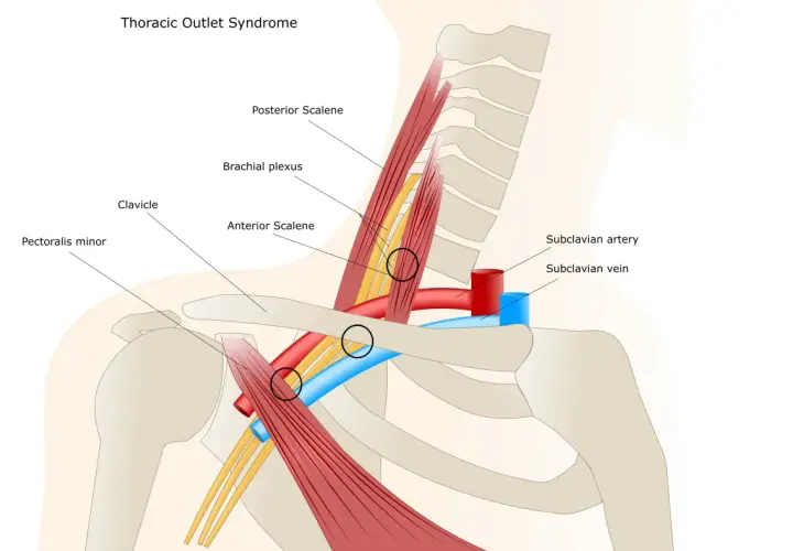 Illustrazione anatomica che mostra le strutture coinvolte nella sindrome dello stretto toracico. Evidenzia la compressione del plesso brachiale e dei vasi sanguigni.