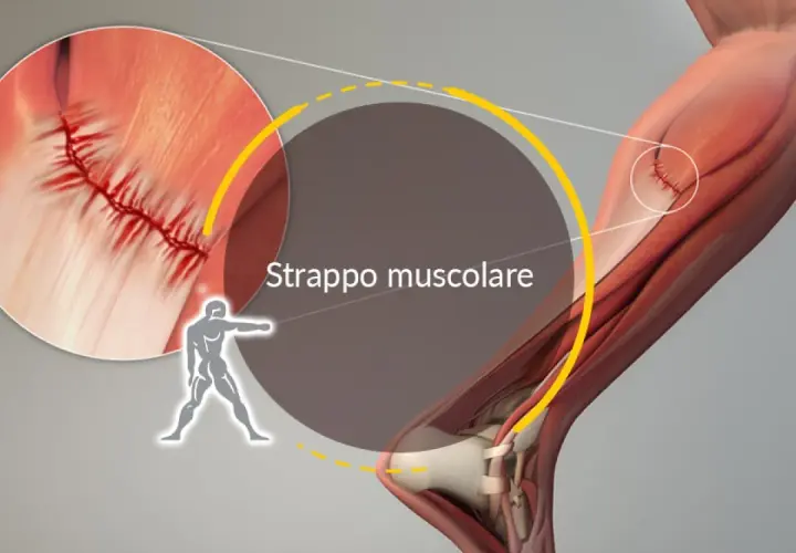 Dettaglio di uno strappo muscolare con suture. L'immagine illustra la lesione e i tempi di recupero.