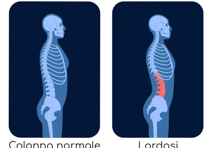 Confronto tra colonna vertebrale normale e lordosi. La lordosi cura è un percorso per correggere l'eccessiva curvatura lombare.