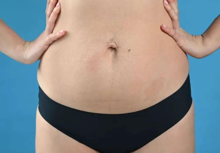 Addome con smagliature, un ombelico e un neo. La tecnica Tupler può aiutare a migliorare l'aspetto.