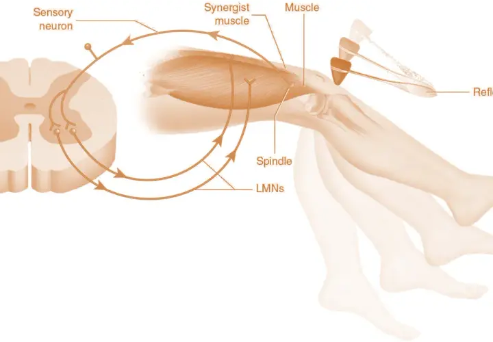 Schema del riflesso patellare: martelletto colpisce ginocchio, innescando un segnale nervoso che, passando per il midollo spinale, causa contrazione muscolare e movimento della gamba, evidenziando l'ipertono muscolare.