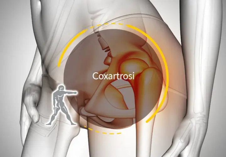 Illustrazione anatomica dell'anca con la scritta "Coxartrosi". Un omino stilizzato indica la zona dolente, suggerendo che si guarisce da coxalgia.