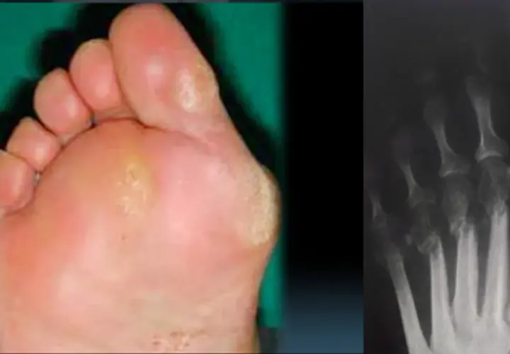 Piede con callosità e radiografia delle ossa metatarsali, possibili cause di metatarsalgia.