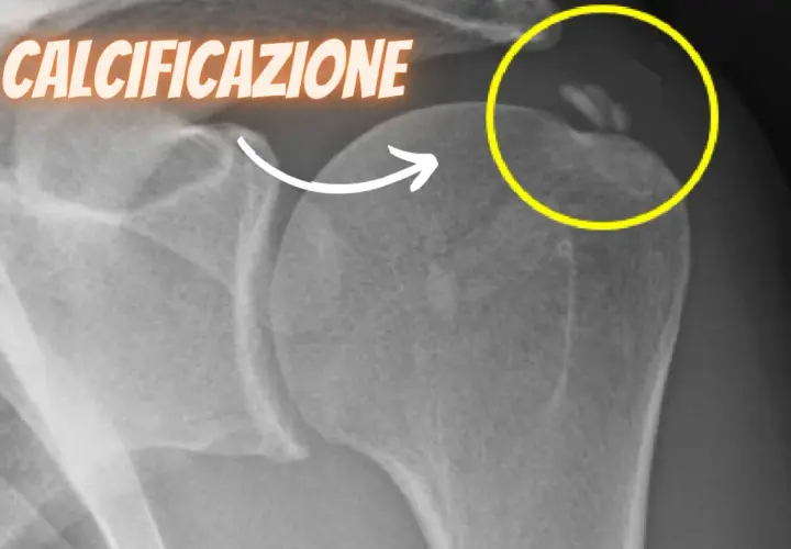 Radiografia spalla: calcificazioni evidenziate in giallo, indicative di tendinopatia calcifica.