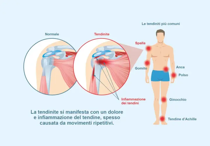 Illustrazione che mostra la differenza tra un tendine normale e uno infiammato, evidenziando le zone più colpite dalla tendinite e come si cura.