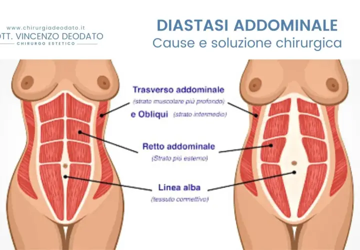 Illustrazione anatomica addominale che mostra la diastasi addominale, una condizione che può peggiorare se non trattata.