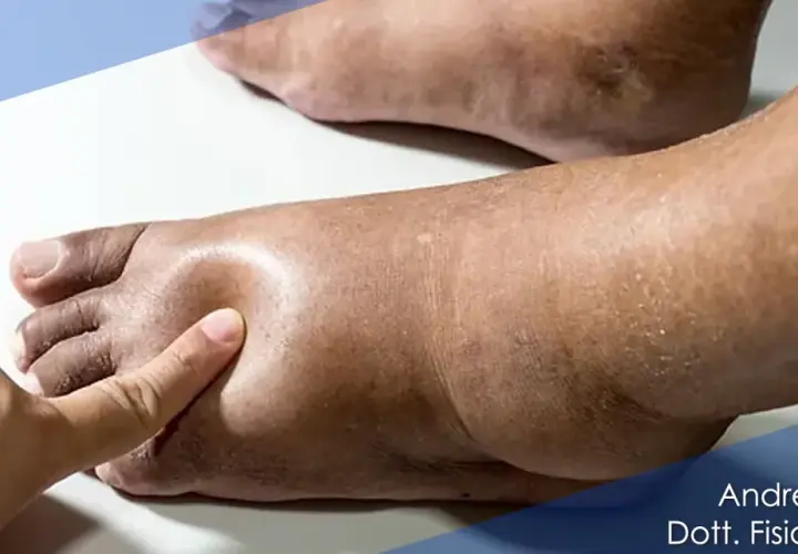 Piede gonfio con evidente imbibizione edematosa, segno di accumulo di liquidi.