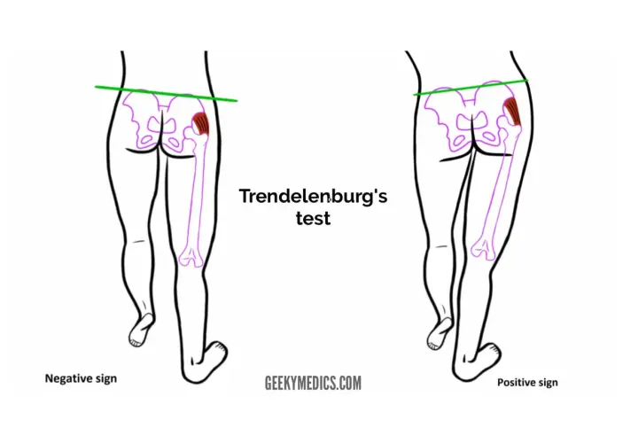 Illustrazione del test di Trendelenburg: bacino livellato (negativo) vs. bacino inclinato (positivo), evidenziando la debolezza del gluteo medio.