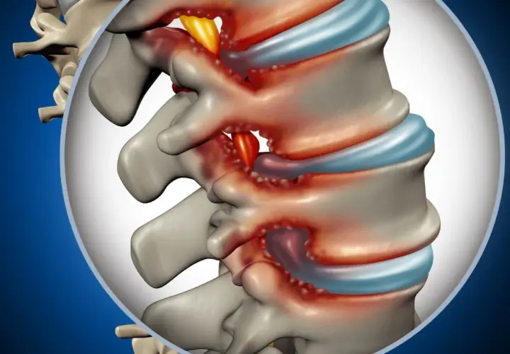 Dettaglio anatomico della colonna vertebrale lombare con infiammazione e compressione nervosa. Si può guarire da una stenosi lombare con le giuste cure.