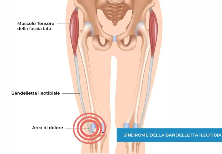 Illustrazione anatomica del ginocchio che mostra la bandelletta ileotibiale e l'area di dolore, indicando la sindrome della bandelletta ileotibiale che non guarisce.