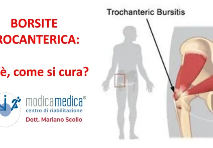 Illustrazione anatomica della borsite trocanterica, con indicazione della zona interessata e del centro di riabilitazione Modicamedica.