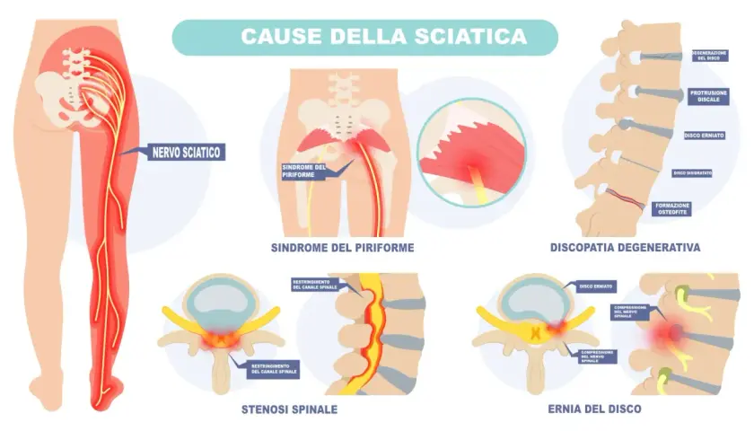 Illustrazione delle cause della sciatica: nervo sciatico, sindrome del piriforme, discopatia degenerativa, stenosi spinale ed ernia del disco. Addio al dolore del nervo sciatico.