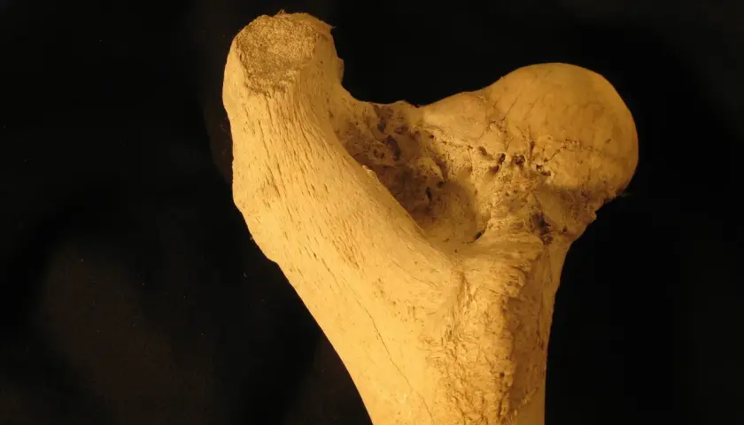 Frammento osseo con segni di necrosi testa femore. La terapia farmacologica è fondamentale per contrastare questa condizione.