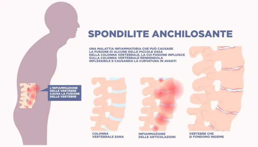 Illustrazione della spondilite anchilosante: infiammazione vertebrale che causa fusione, rigidità e curvatura. La durata vita non è influenzata significativamente.