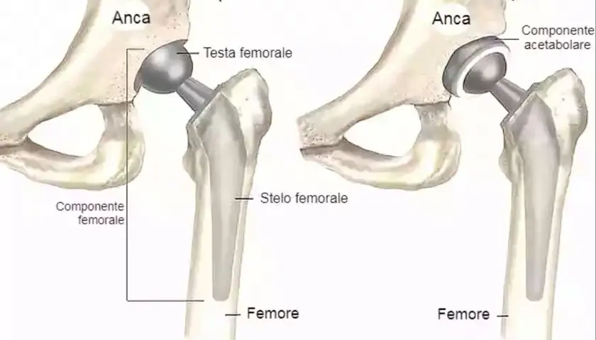 Illustrazione comparativa di protesi d'anca: endoprotesi e artroprotesi. La protesi totale d'anca sostituisce l'articolazione danneggiata.
