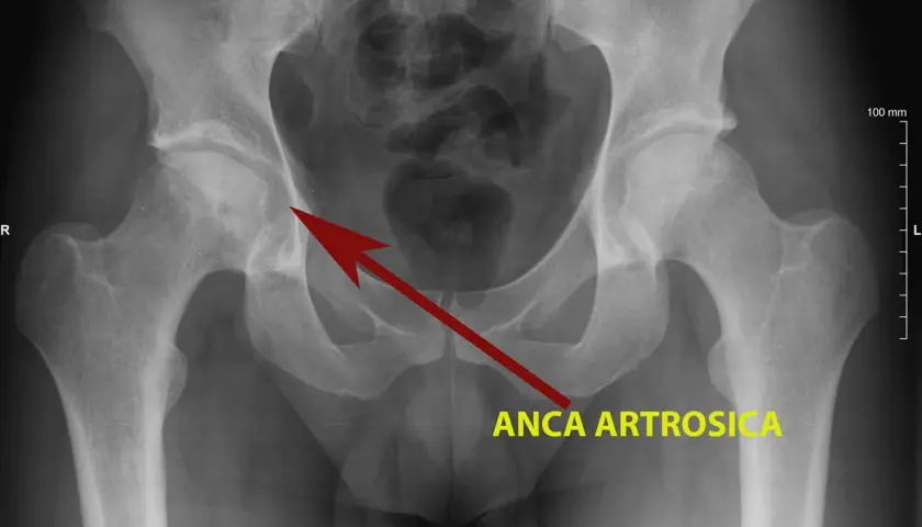 Radiografia del bacino che mostra un'anca artrosica, con freccia rossa che indica l'area interessata, suggerendo possibili coxalgia sintomi.