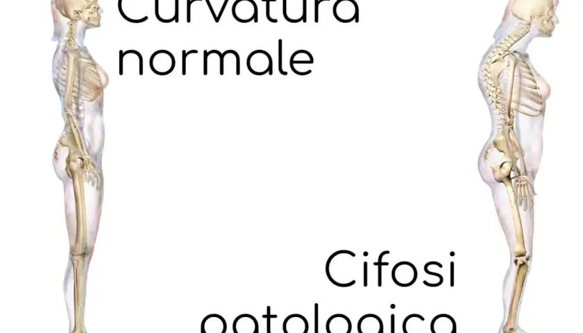 Confronto tra colonna vertebrale con curvatura normale e cifosi patologica. Si guarisce dalla cifosi?