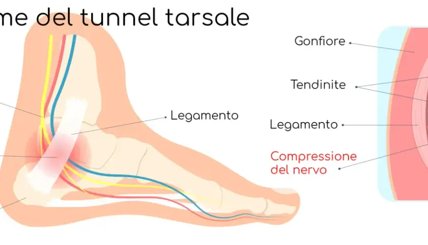 Illustrazione anatomica del tunnel tarsale: nervo tibiale posteriore compresso, gonfiore e tendinite.