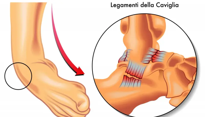 Illustrazione di una caviglia con un cerchio che evidenzia la zona interessata da una rottura dei legamenti, mostrando la sindesmosi caviglia.