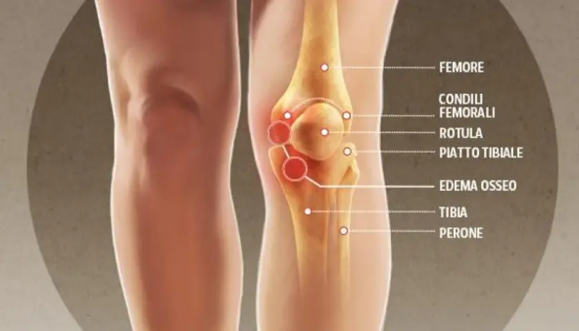 Illustrazione anatomica del ginocchio con evidenziato l'edema osseo.