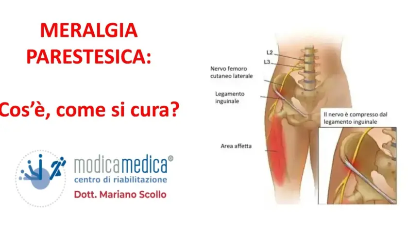 Meralgia parestesica: illustrazione del nervo femorale compresso, con sintomi e area affetta.