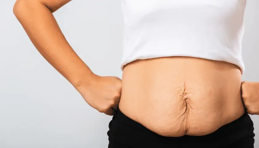 Addome con smagliature e diastasi addominale: cosa fare per recuperare tonicità e benessere.