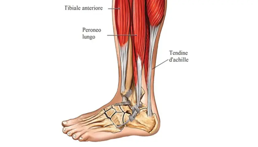 Dettaglio anatomico della gamba e del piede, con evidenziato l'ispessimento del tendine d'Achille.