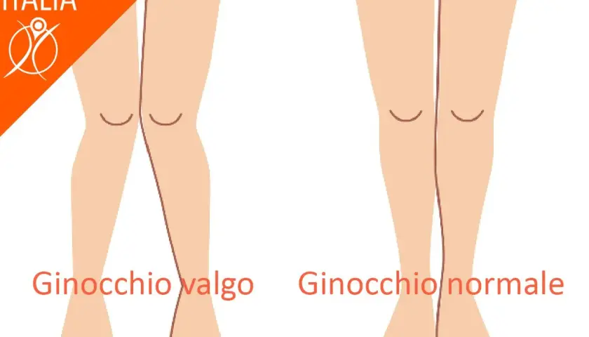 Confronto ginocchio valgo e ginocchio normale, utile per il valgus stress test.