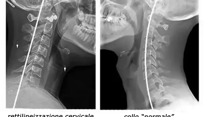 Radiografie del collo: a sinistra, rettilineizzazione cervicale con riduzione della lordosi; a destra, collo "normale".