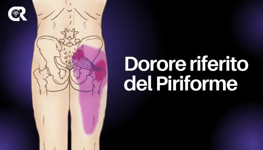Dolore riferito del piriforme: un'illustrazione anatomica mostra l'area del gluteo e della gamba interessata da infiammazione.