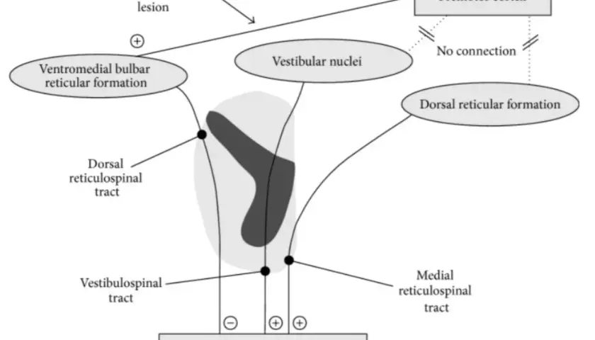 Schema che illustra la spasticità indotta da lesioni sovraspinali, con percorsi che influenzano il circuito del riflesso da stiramento, rilevante per la scala Ashworth.