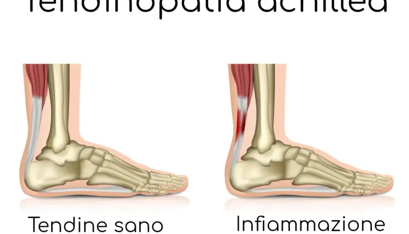 Confronto anatomico: tendine d'Achille sano e infiammato, causa di bruciore ai talloni a riposo.