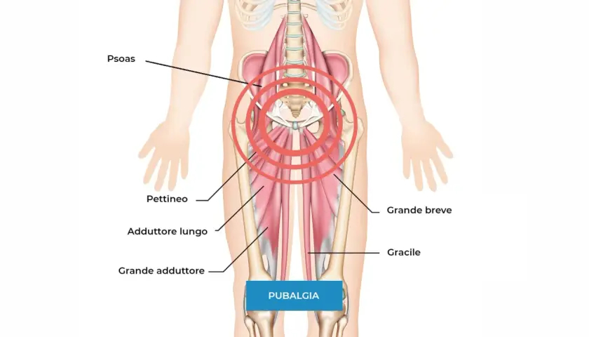 Illustrazione anatomica che mostra i muscoli adduttori e il psoas, aree spesso coinvolte nella pubalgia. Scopri i rimedi.