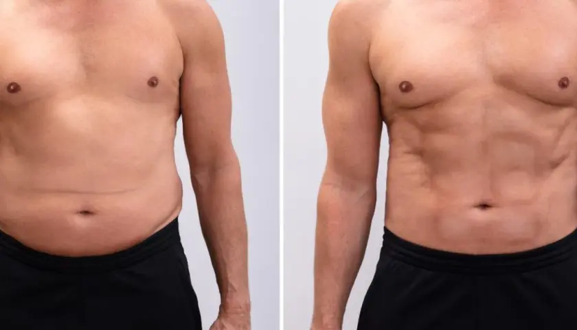 Uomo prima e dopo il trattamento per la diastasi addominale. La pinna addominale è visibilmente ridotta.